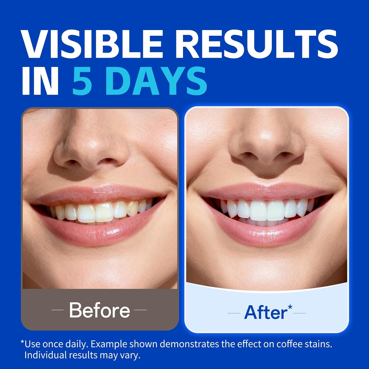 7 çift Diş Beyazlatma Şeritler - Teeth Whitening Retainer incelemesi ve fiyatı