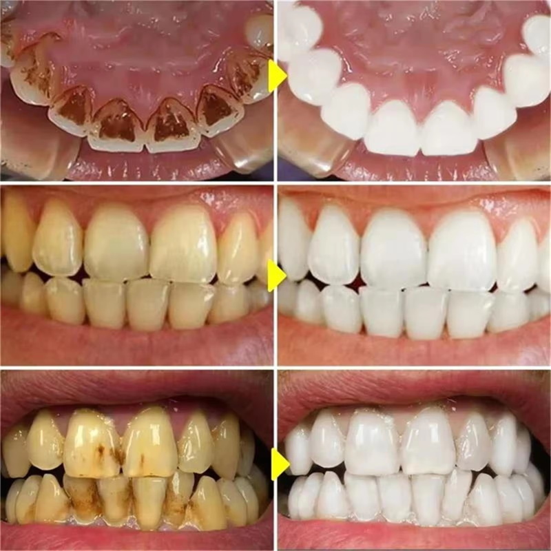 V34 Diş Beyazlatma Kalemi Diş  - Whitening Pen Bleach incelemesi ve fiyatı