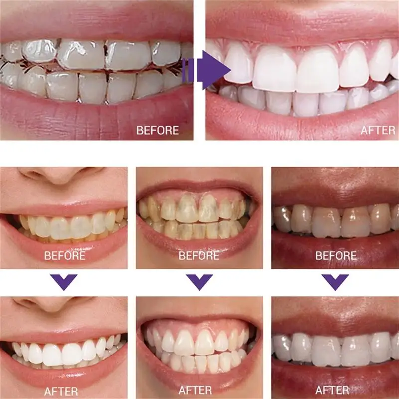 Hızlı Diş Beyazlatma Diş Macun - Whitening Pen Bleach incelemesi ve fiyatı